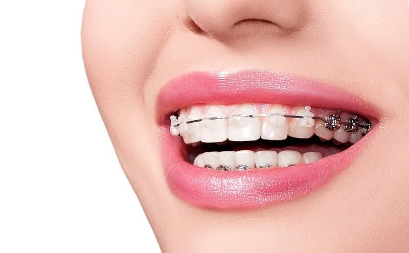 GIÁ NIỀNG RĂNG TRẢ GÓP TẠI HÀ NỘI