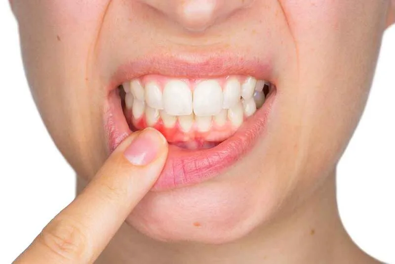 7 CÁCH TRỊ TỤT NƯỚU RĂNG TẠI NHÀ ĐƠN GIẢN