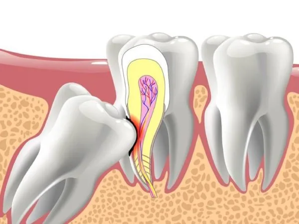 Sâu Răng Số 7 Do Răng Khôn Và Phương Pháp Điều Trị Hiệu Quả
