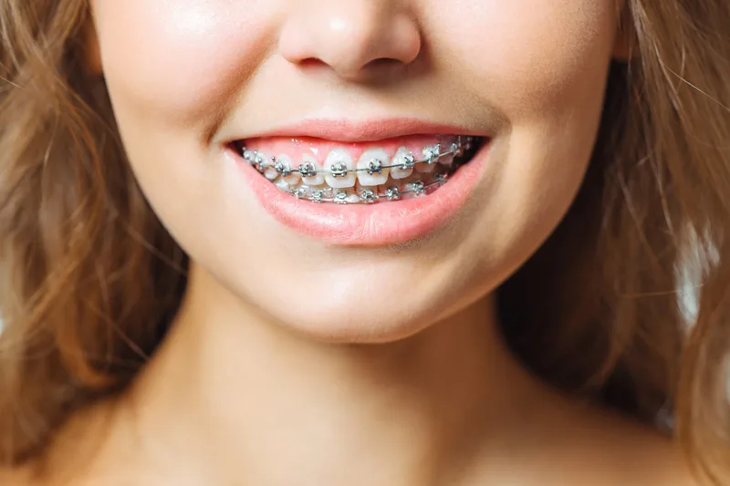 CHỈNH 1 RĂNG LỆCH GIÁ BAO NHIÊU?