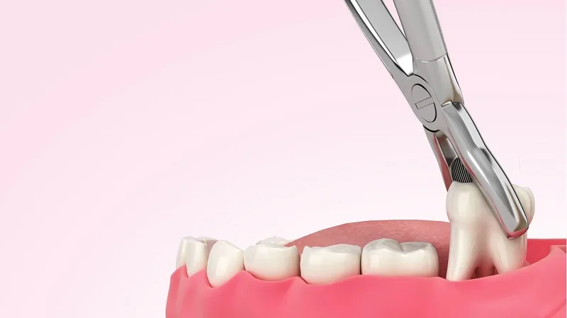 Vết khâu nhổ răng khôn bị hở: Nguyên nhân, biểu hiện, cách điều trị