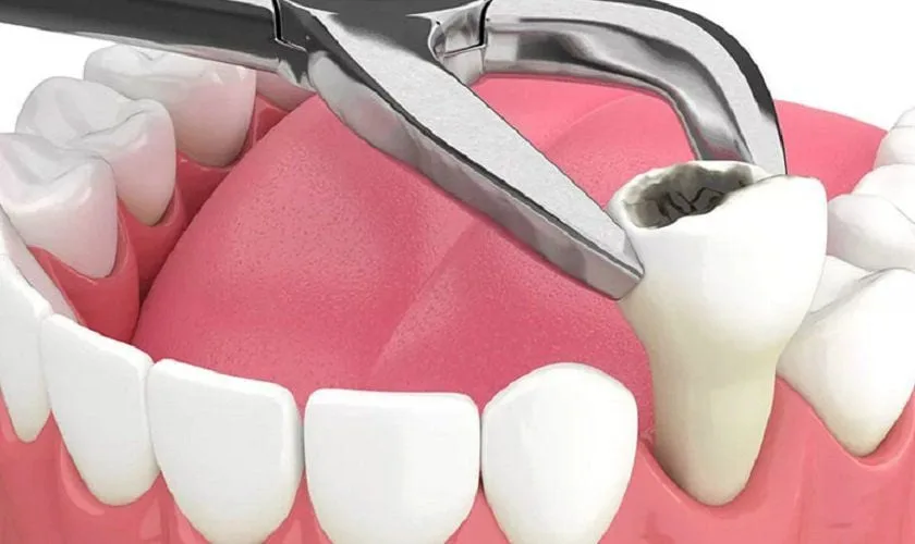 Có nên nhổ răng khôn trong kỳ kinh nguyệt không?