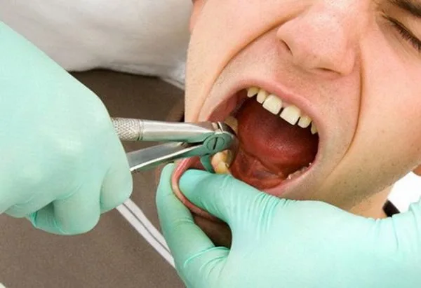 Vỡ cục máu đông sau khi nhổ răng có sao không?