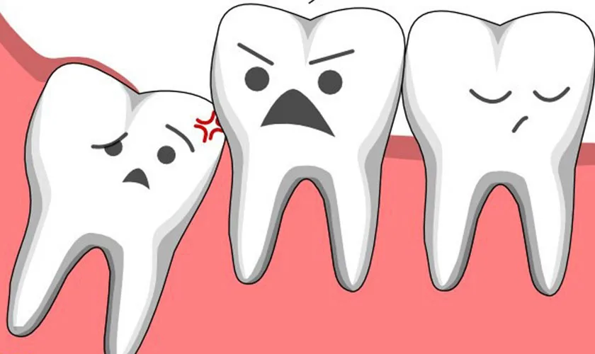 Răng Khôn Tiếng Anh Là Gì? Từ Vựng Nha Khoa Tiếng Anh Phổ Biến Bạn Cần Biết