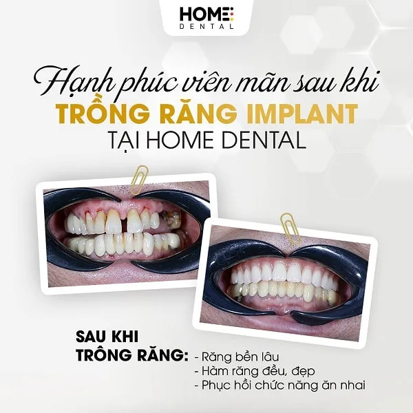 Trồng răng implant toàn hàm là gì?