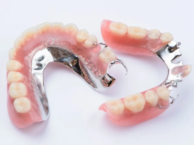 Hàm khung liên kết: Khái niệm, Quy trình lắp đặt và Cách chăm sóc