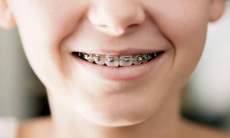 Niềng răng cho trẻ 14 tuổi giá bao nhiêu tiền?