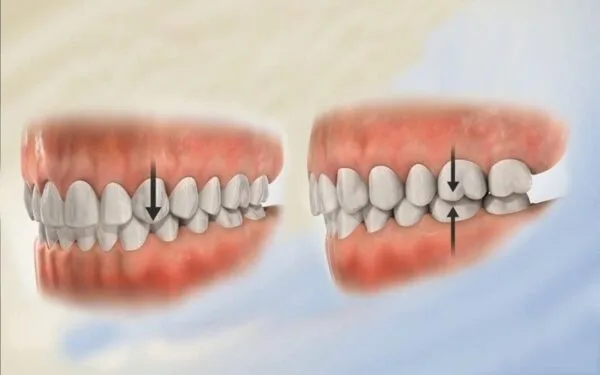 Bọc răng sứ bị lệch khớp cắn – Tổng hợp thông tin chi tiết