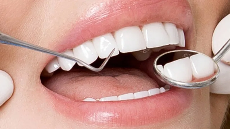 Mài răng cho đều giá bao nhiêu?