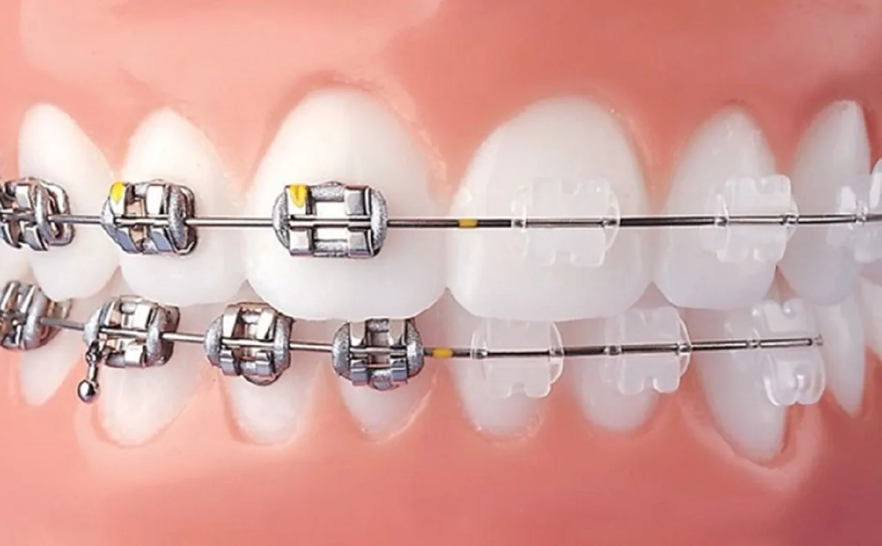 Top 5 Loại Mắc Cài Niềng Răng Phổ Biến Hiện Nay