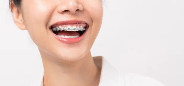 Niềng răng một hàm có ảnh hưởng đến ăn nhai không