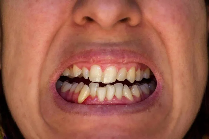 Răng quặp vào trong có niềng được không?