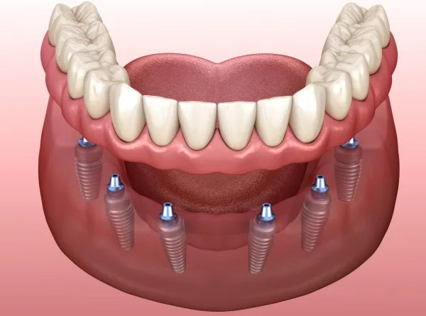 Trong rang toan ham Implant All On 4 