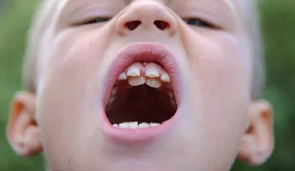 Trẻ em mọc răng không theo thứ tự ảnh hưởng gì