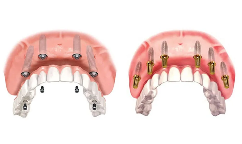 Trong rang Implant toan ham All on 4 va All on 6