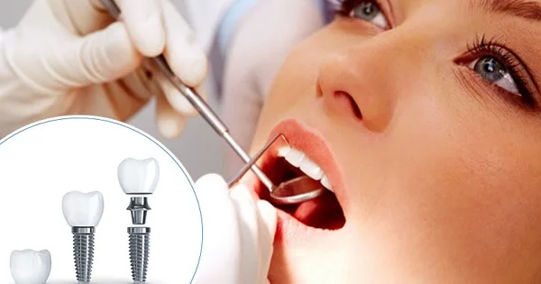 kham tong quat de thuc hien trong rang implant