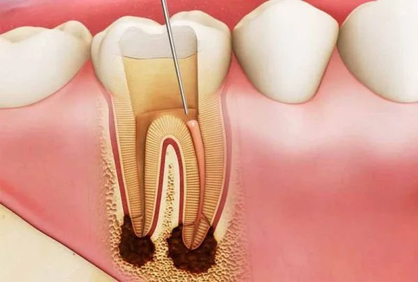 Áp xe răng sữa có nên chắc chắn nhổ không?