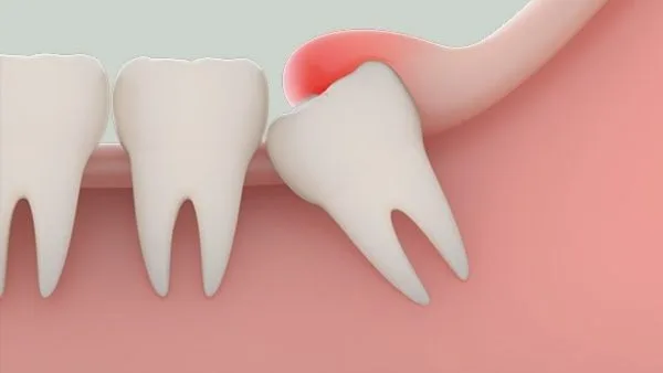 Bị áp xe răng khôn có nên tiến hành nhổ hay không?