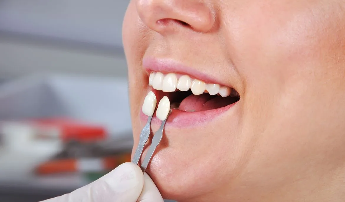 Dán sứ Lisi có bền không? Giá bao nhiêu?