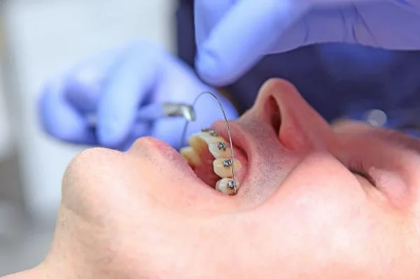 Kéo răng ngầm mất bao lâu? Các lưu ý quan trọng bạn cần biết