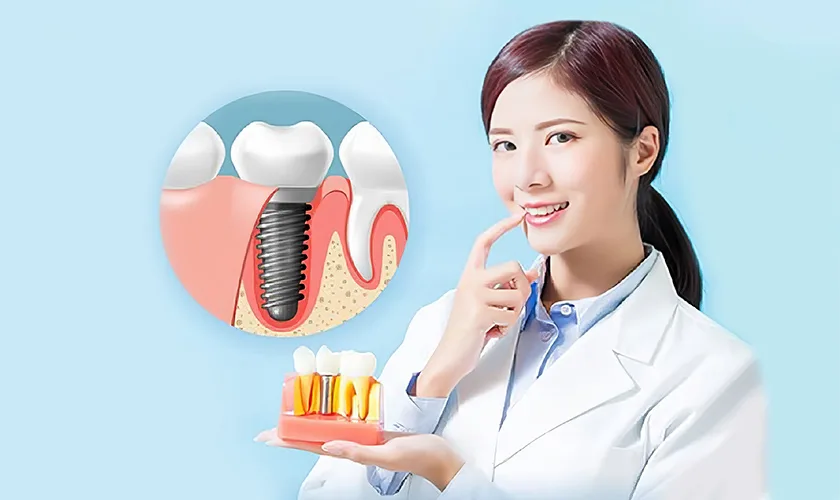 Cấy Implant Có Khắc Phục Tình Trạng Má Hóp Không? Giải Pháp Hiệu Quả!