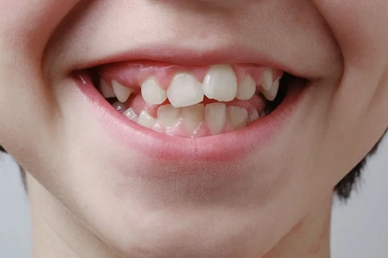 Cách chỉnh răng mọc lệch tại nhà