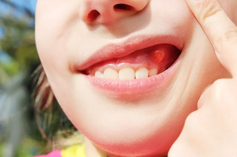 Mọc mụn ở lợi chân răng là bệnh gì?