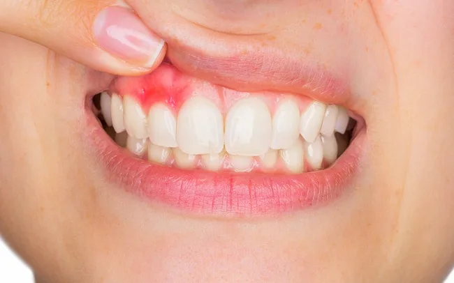 Áp Xe Răng Có Mủ: Nguyên Nhân, Triệu Chứng và Cách Điều Trị Hiệu Quả