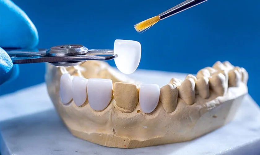 Phương Pháp Dán Răng Sứ Không Mài Răng Là Gì?