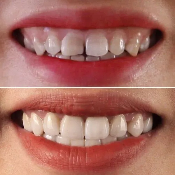 Bọc răng sứ có làm thay đổi khuôn mặt không