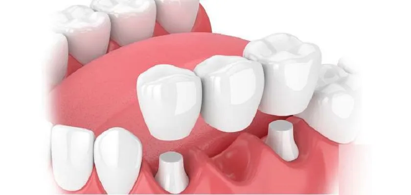Dán răng sứ hay bọc răng sứ tốt hơn?