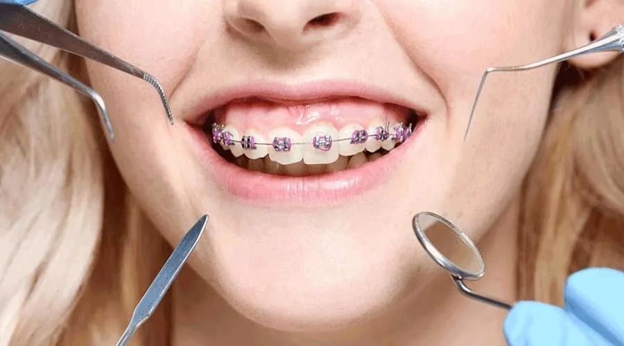 Giá chỉnh răng bao nhiêu tiền? Bảng phí niềng răng cập nhật 2025