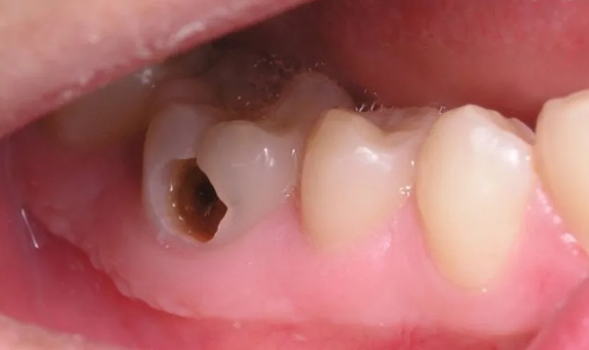 8 cách trị nhức răng có lỗ tại nhà – Hiệu Quả Bất Ngờ, Dễ Thực Hiện