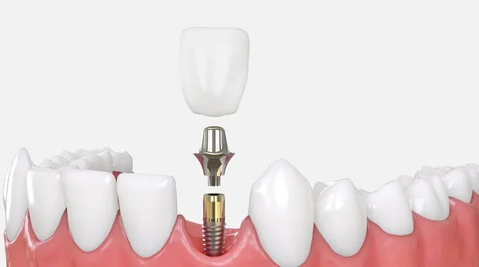 cam-ghep-rang-implant