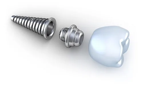 cau-tao-rang-implant