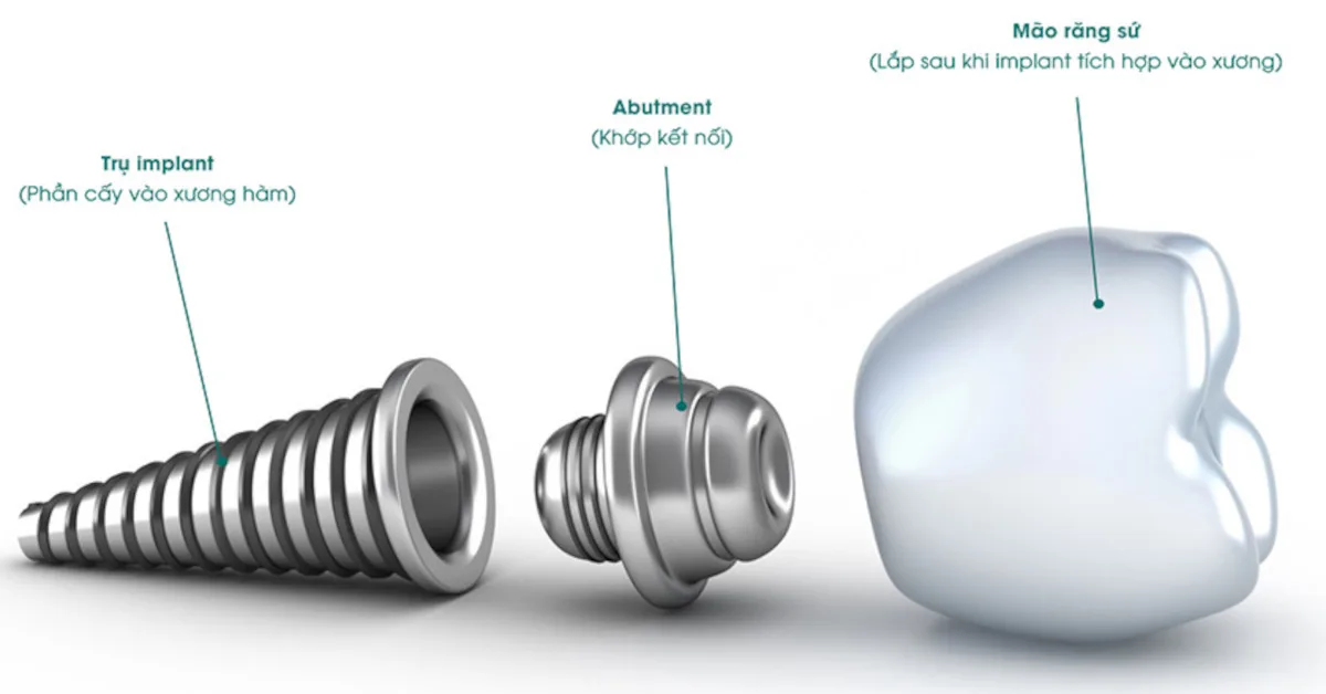 cau tao trong rang implant