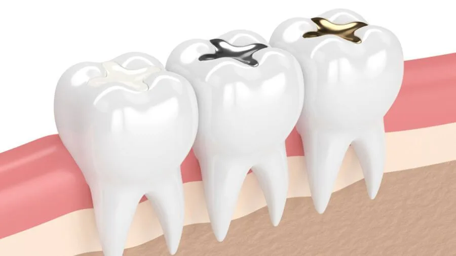 Răng sâu vào tủy có hàn được không?
