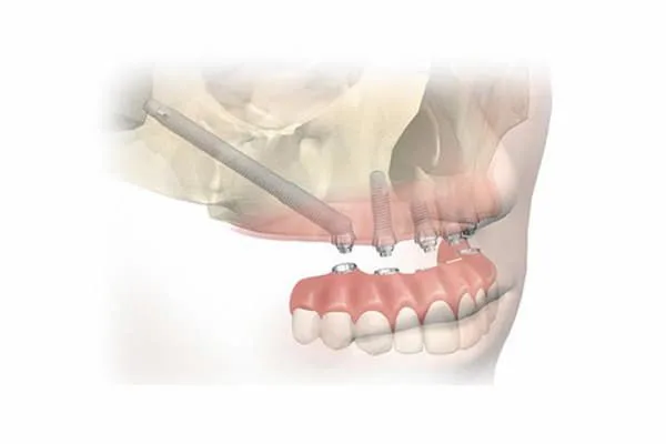 Cấy ghép implant xương gò má là gì?