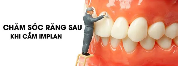 Chăm sóc răng sau khi cắm implant như thế nào?