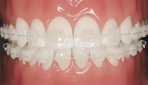 Mắc cài sứ
