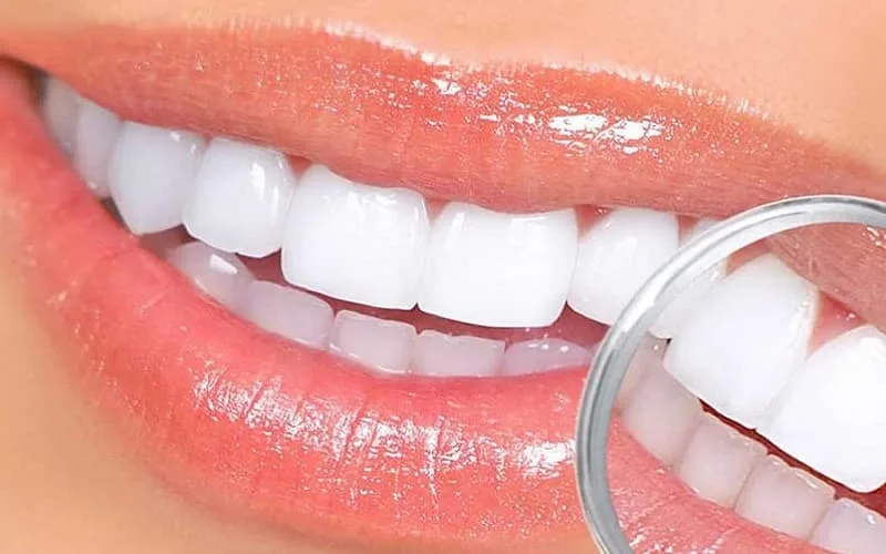Có nên dán răng sứ Veneer toàn hàm không?