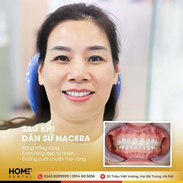 Khách hàng dán răng sứ nacera
