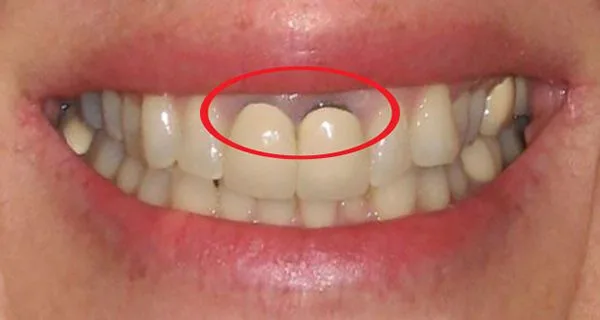 Dấu hiệu bọc răng sứ bị hở chân răng