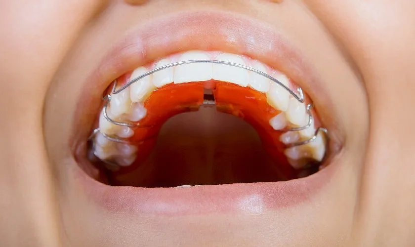 Hàm duy trì Hawley là gì? Những điều cần biết về loại hàm này