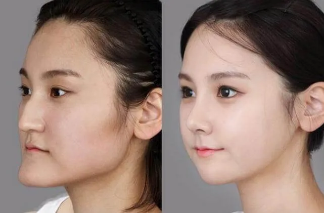 Mặt lưỡi cày là tướng tốt hay xấu? Có Khắc phục được không?