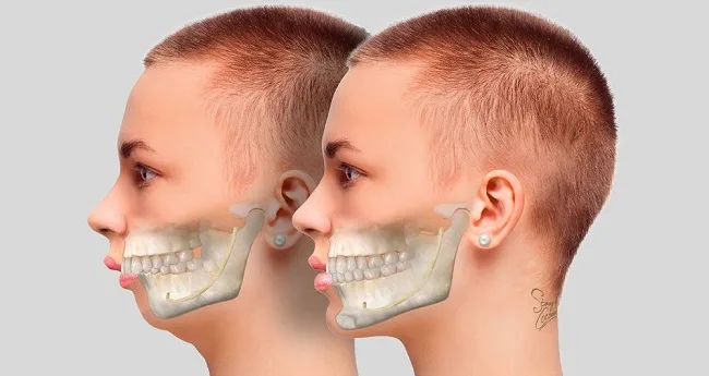 Răng Hô Nhẹ Là Như Thế Nào? Tìm Hiểu Về Tình Trạng Răng Hô Nhẹ
