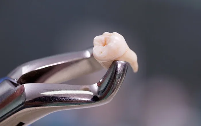 Nguyên nhân nhổ răng số 8 không cầm được máu