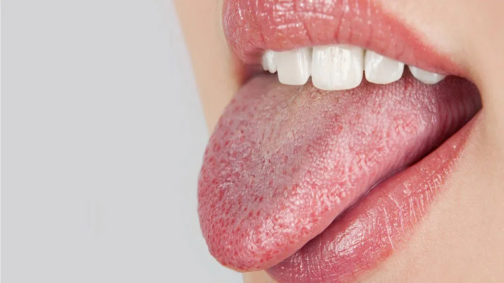 Lưỡi Nổi Hạt Đỏ: Nguyên Nhân, Triệu Chứng và Giải Pháp Điều Trị Hiệu Quả