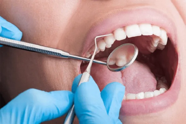 Việc lấy cao răng có lợi ích gì?