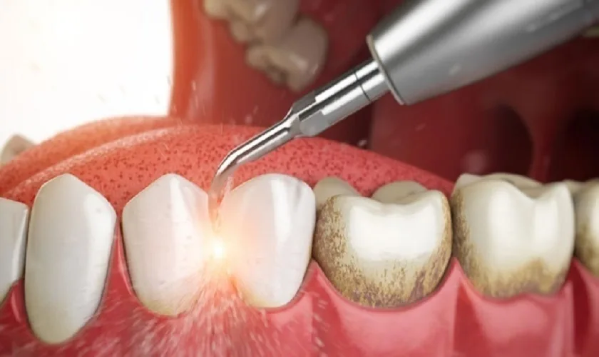 Lấy cao răng 30k có đáng tin hay không? Các điều cần lưu ý